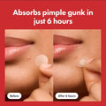 Patchs Anti-Boutons Acne Cover (Lot de 24)