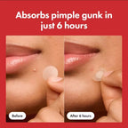 Patchs Anti-Boutons Acne Cover (Lot de 24)
